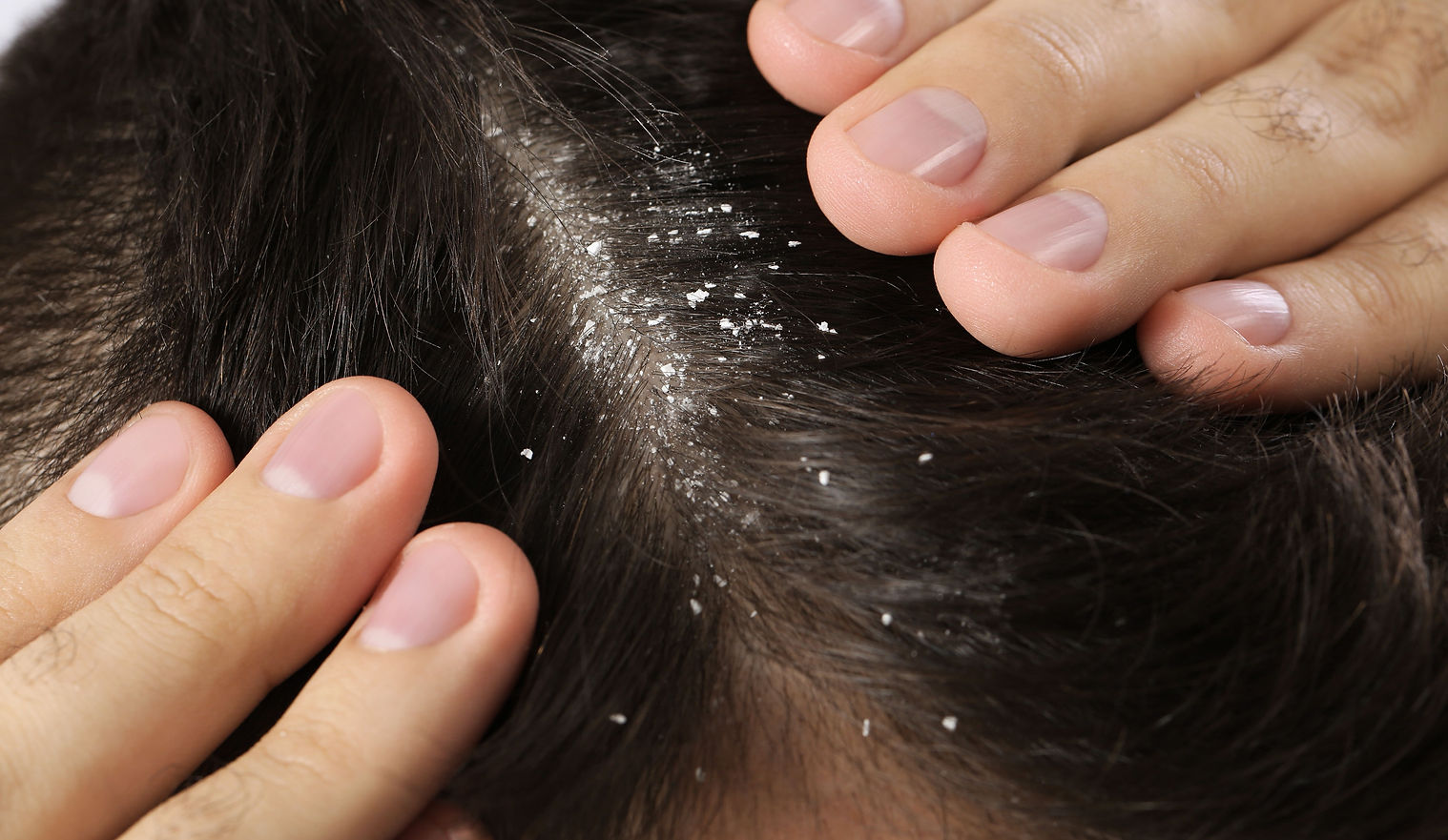 Man with dandruff in his dark hair, macro view.jpg