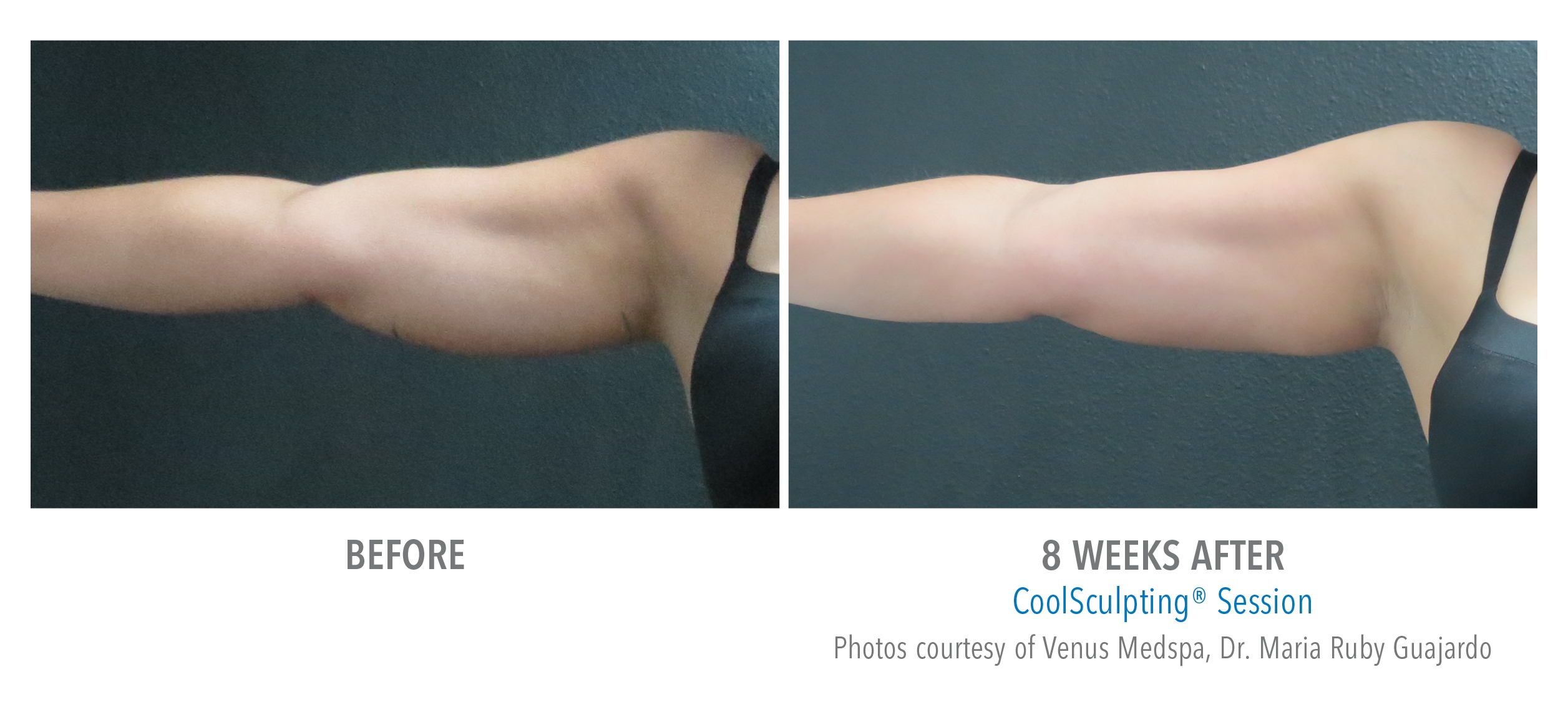 Photos Coolsculpting Venus Medspa McAllen