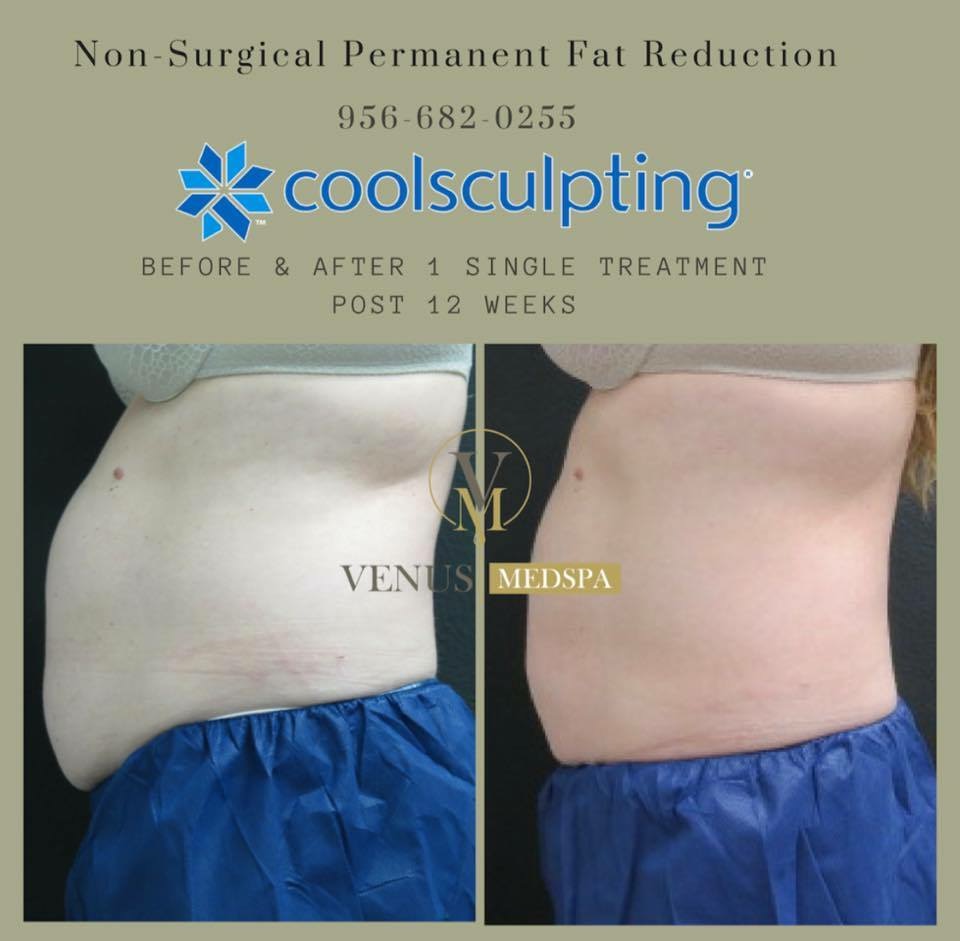 Photos Coolsculpting Venus Medspa McAllen