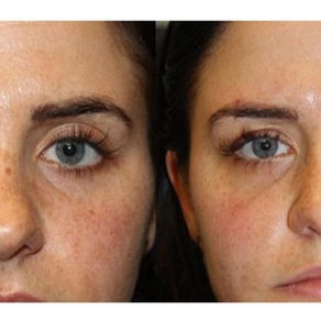 Rise your eyelids with only a drop