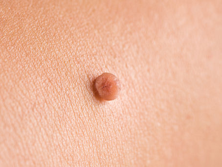 Understanding Skin Tags: Causes and Removal Options