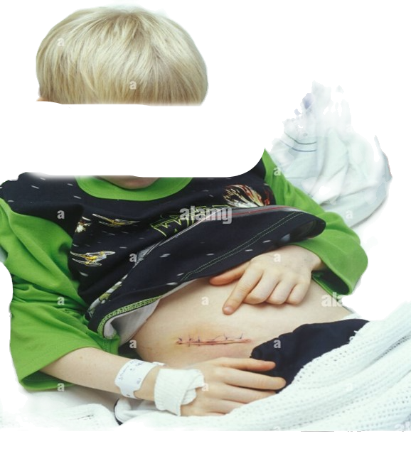 Bowen Technique for Scar Tissue