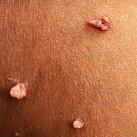 skin tags and irregularity