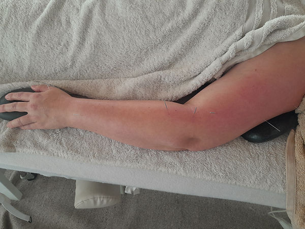 Acupuncture RSI left arm.jpg