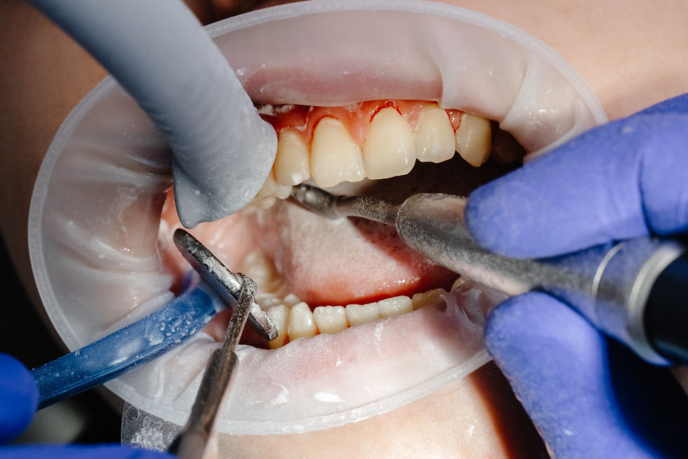 bleeding gums