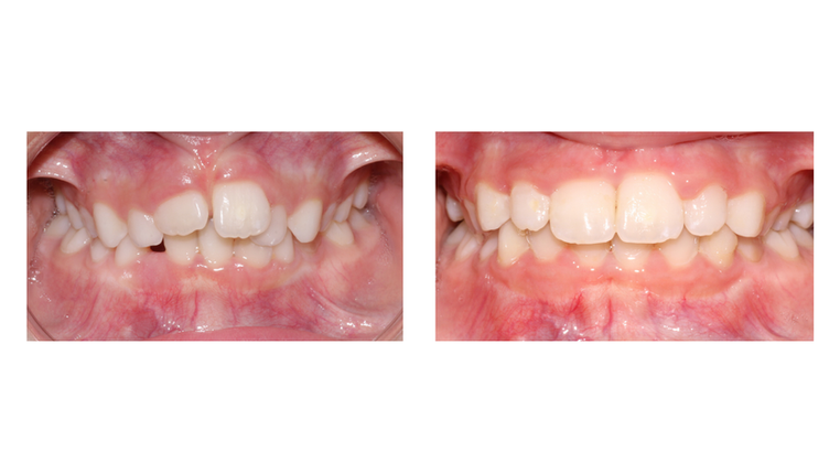 Teeth before and after braces