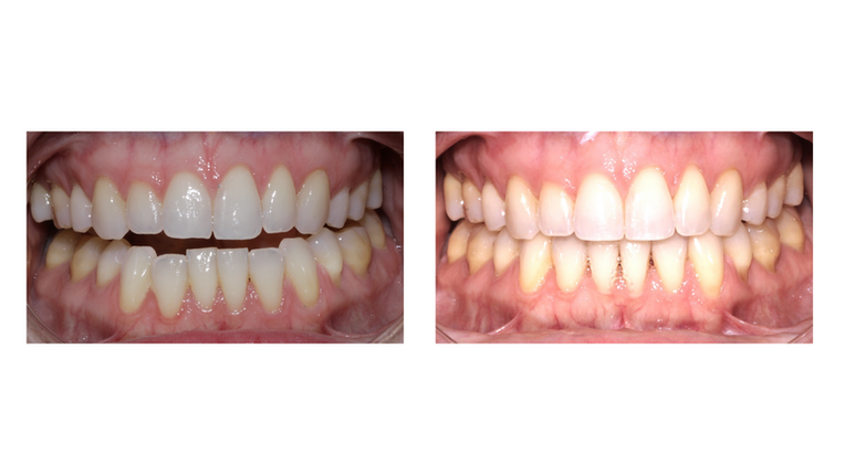 Teeth before and after braces