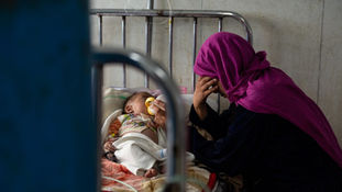 One Million Children in Afghanistan Face the Most Severe Form of Malnutrition