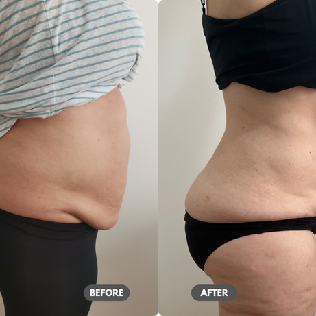 Synergy Skin and Body Therapy Melbourne Liposuction Body Contouring Beauty Melbourne