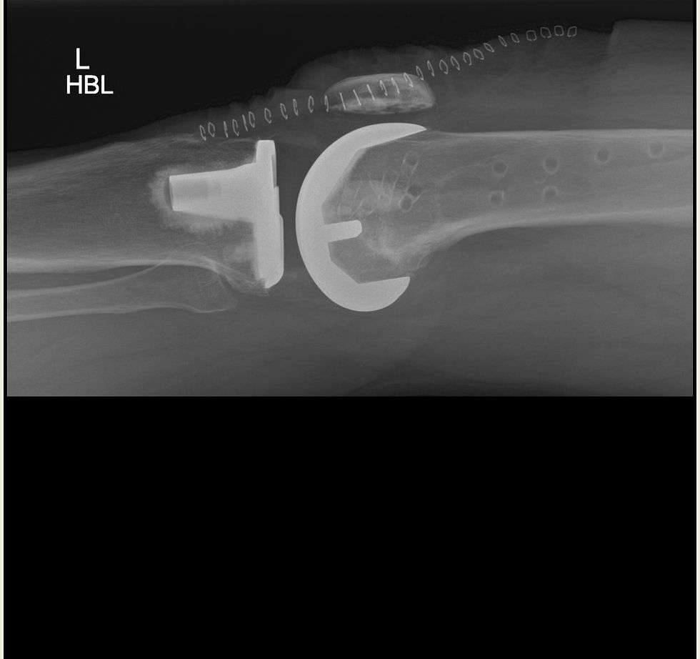 Back home with a new knee! Anything happen?