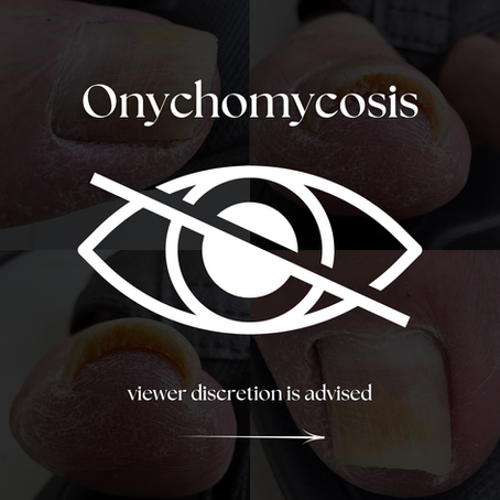 Let’s Talk Onychomycosis: When Nail Health Comes First