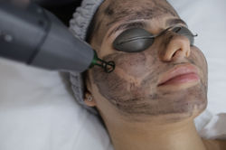 Laser Black Peel