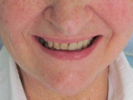 Sorriso envelhecido