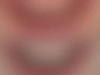 DESMISTIFICANDO FACETAS E LENTES DENTAIS: SAIBA COMO FUNCIONAM E QUAIS AS SUAS INDICAÇÕES.