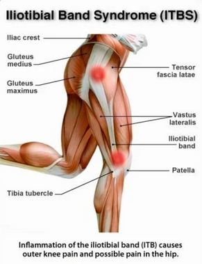 Sports Massage Sydney Eastern Suburbs: Why Runners Keep Getting ITB Syndrome Wrong