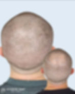 Male Pattern Baldness SMP