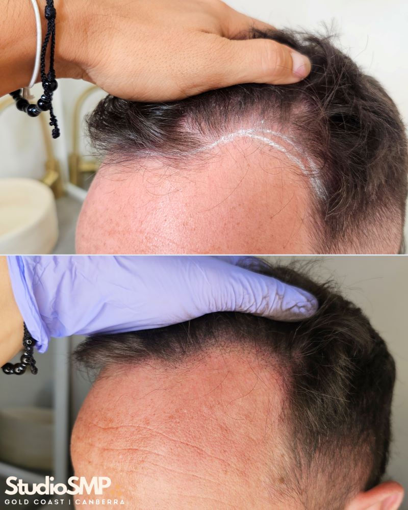 Hairline Density SMP