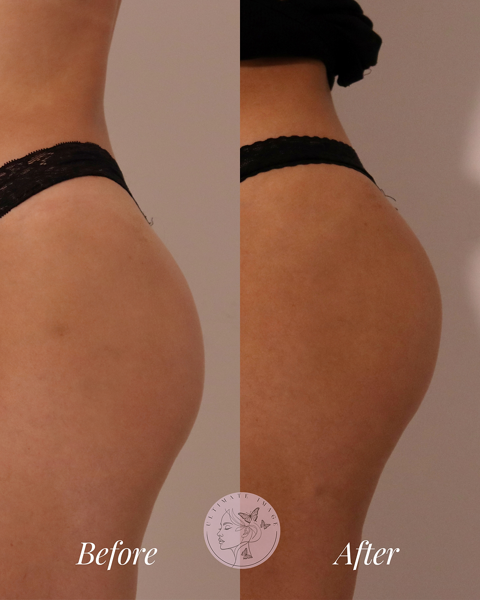 Enhance and lift your natural curves with a non-surgical approach