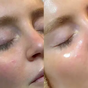 Is a Deluxe Hydrafacial Worth It? What Makes It Different From a Regular Facial