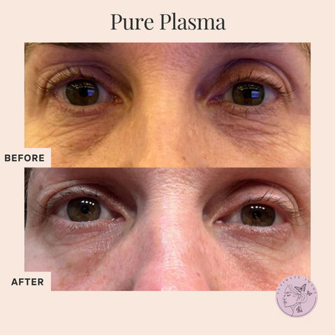 Laser Resurfacing