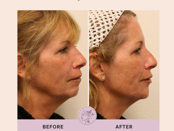 Enhance and balance the shape of the jaw