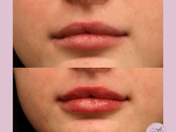 Enhance the shape and volume of lips