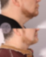 Tighten and lift sagging skin for a more youthful appearance