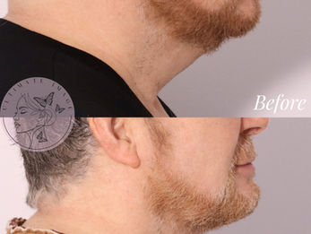 Tighten and lift sagging skin for a more youthful appearance