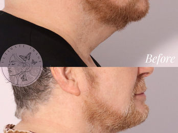 Tighten and lift sagging skin for a more youthful appearance
