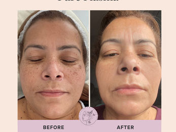 A non-invasive solution to lift, tighten, and refresh your skin.
