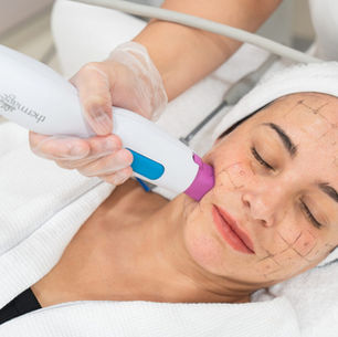 What Makes Thermage One of the Best Summer Skin Tightening Treatments?