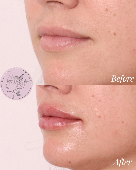 Enhance lip hydration, softness, and subtle volume while maintaining a natural appearance