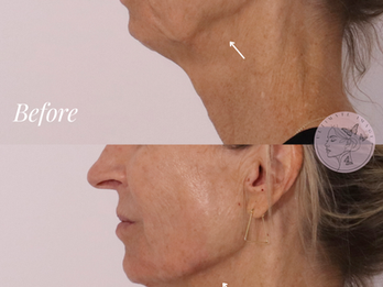 Enhance and define the jawline and chin for a more sculpted appearance
