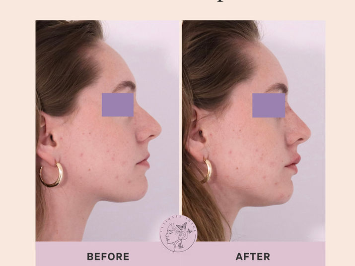 Enhance the shape of the nose