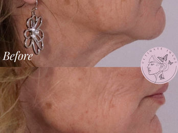 Enhance and balance the shape of the jaw