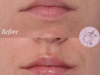 Subtly enhance lip shape, definition, and hydration for a soft, natural-looking result
