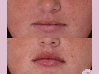 Enhance the shape and volume of lips