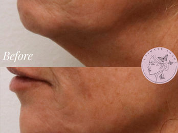 Enhance and balance the shape of the jaw