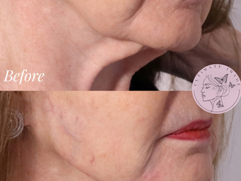 Enhance jawline definition and structure while softening labiomental folds (chin crease) for a smoother, more youthful lower face