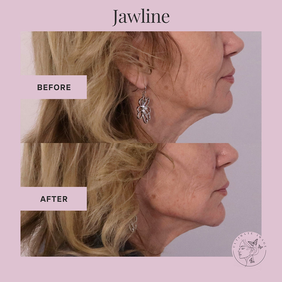 Enhance and balance the shape of the jaw