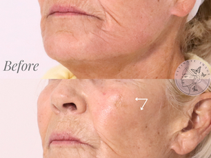 Fraxel Laser Explained: How It Improves Texture, Tone, and Fine Lines