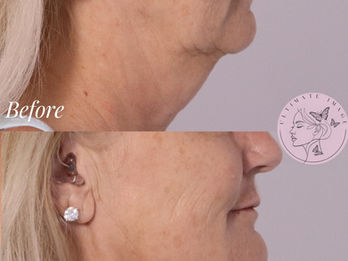 Restore volume and structure to the mid and lower face while softening deeper lines and enhancing lip hydration for a smoother, more youthful, and balanced appearance