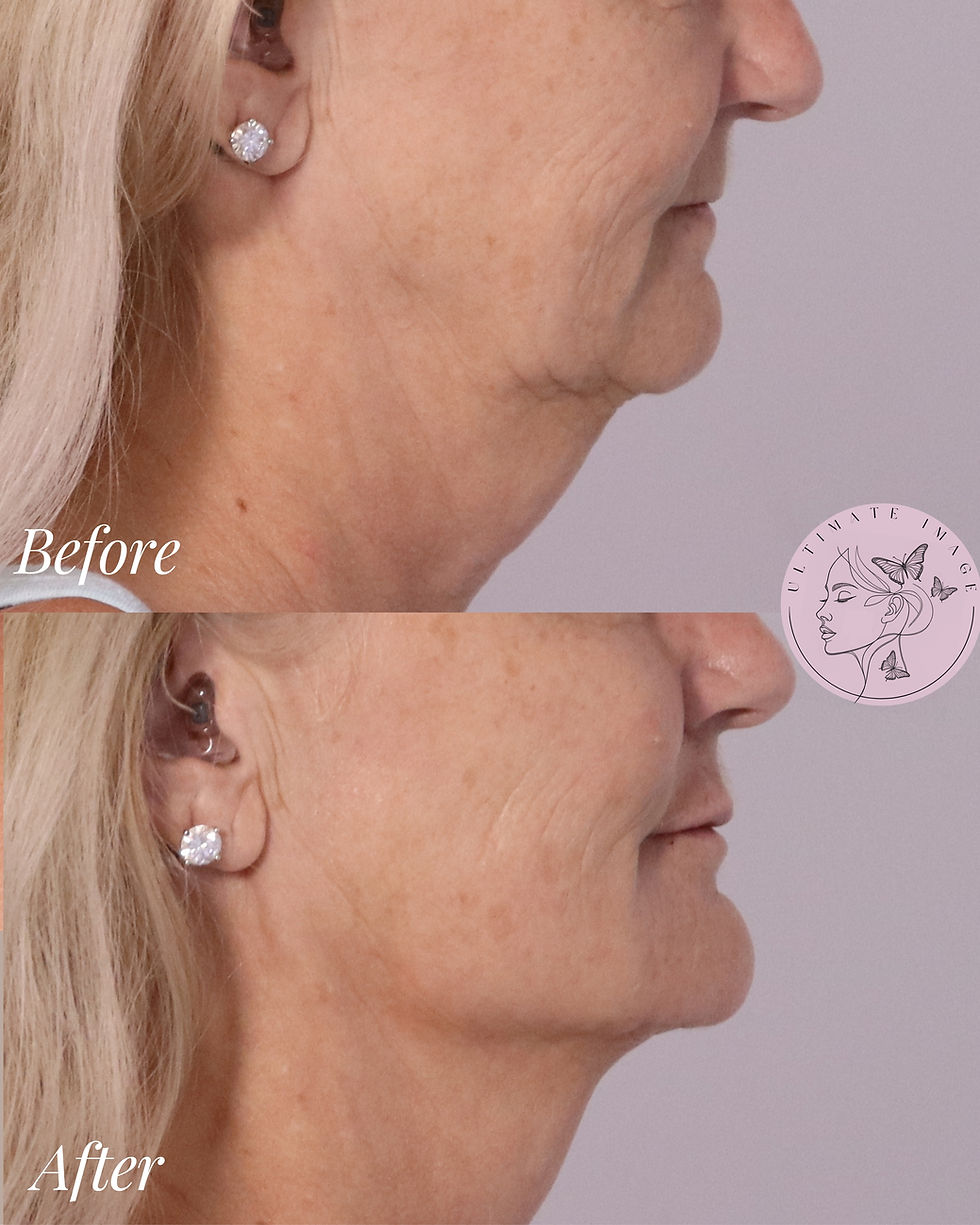 Restore volume and structure to the mid and lower face while softening deeper lines and enhancing lip hydration for a smoother, more youthful, and balanced appearance