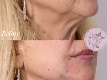 Restore lower-face structure, sharpen the jawline and chin, and soften nasolabial folds and marionette lines for a balanced, refreshed profile