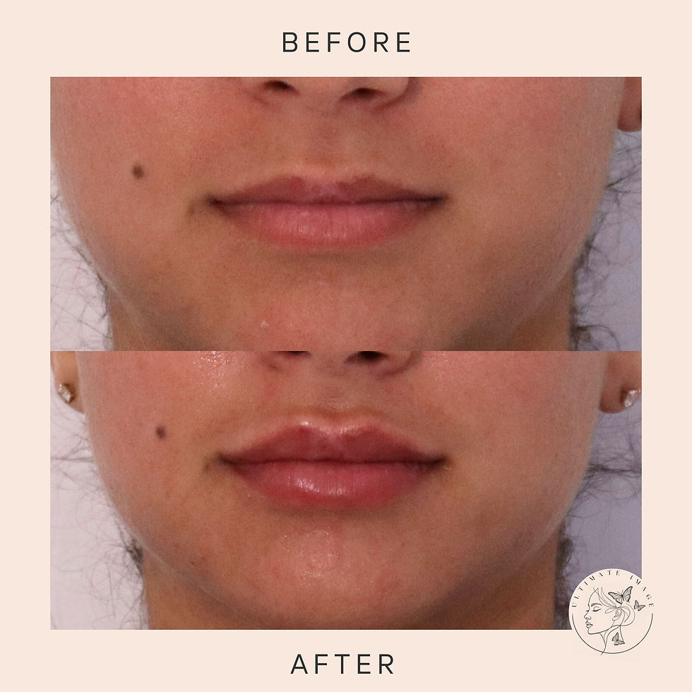 Enhance the shape and volume of lips