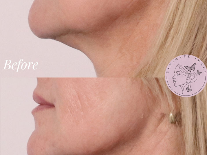 Enhance definition and structure of the jawline while improving contour and supporting collagen production for a more sculpted appearance