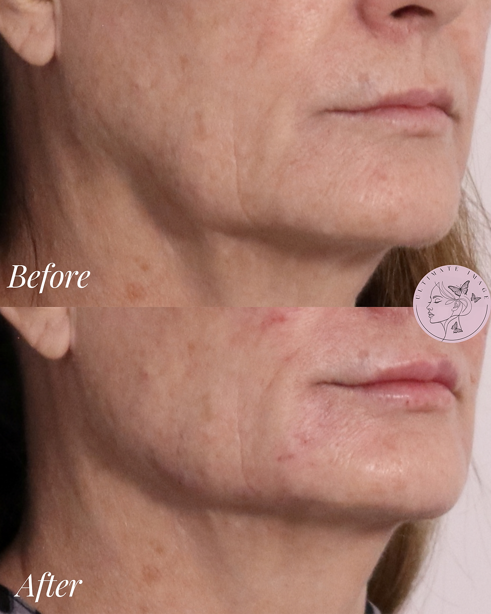 Restore structure and definition through the jawline and cheeks, enhance lip softness and hydration, and smooth nasolabial folds for a more youthful, balanced appearance