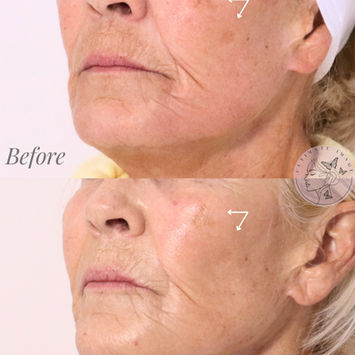 Laser Resurfacing