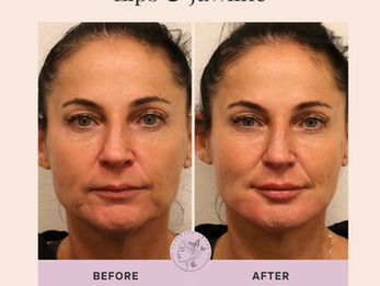 Enhance the symmetry and harmony of the lips and jawline for a more balanced overall appearance