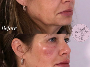Restore harmony and symmetry across the face by refining the lips, smoothing under-eye hollows, sharpening the jawline, and lifting the cheeks for a naturally balanced and youthful appearance